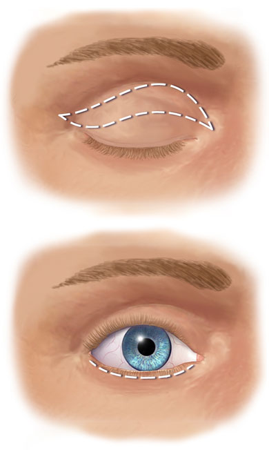 Blefaroplastia superior e inferior