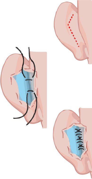 otoplastia cirugia de Orejas de soplillo