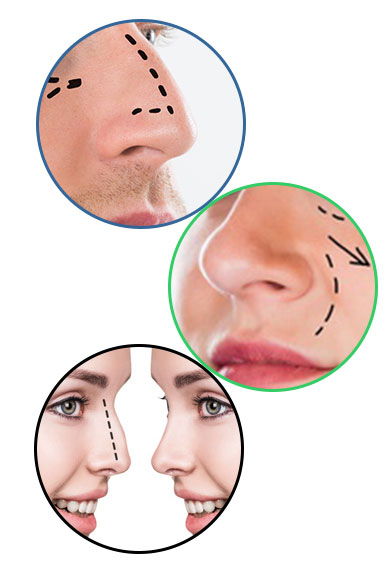 Rinoplastia ultrasonica tipos