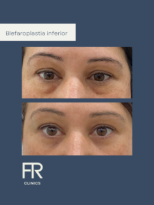 para quie esta indicada la blefaroplastia
