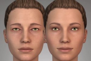 para quien es la blefaroplastia
